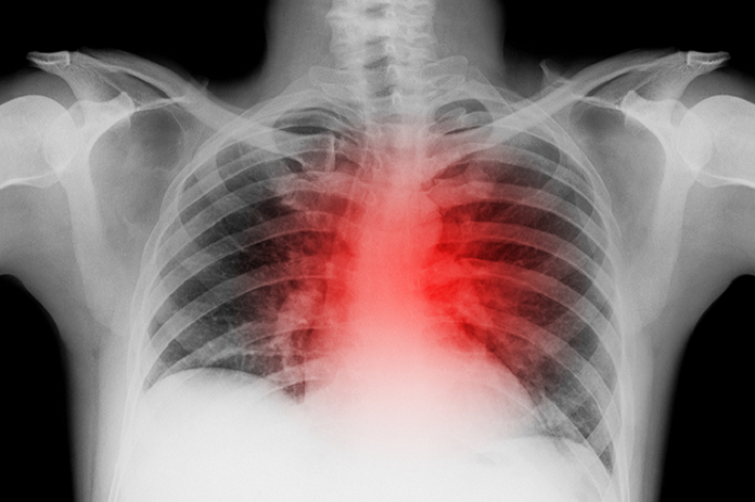 النوبة القلبية: 5 نصائح لتقليل خطر إصابتك