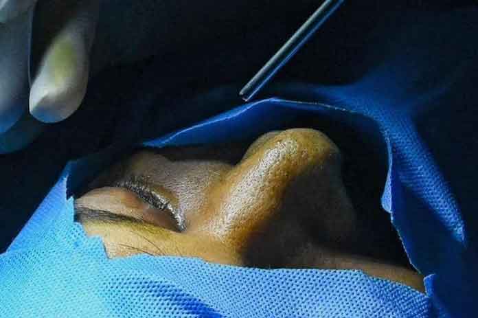 الفطر الأسود العراق