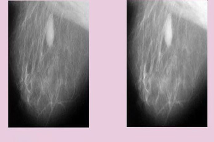 كشف أورام الثدي