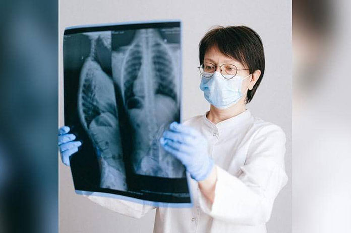 سرطان الرئة