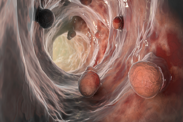 من النظام الغذائي إلى التاريخ العائلي .. 8 عوامل خطر تتعلق بسرطان القولون