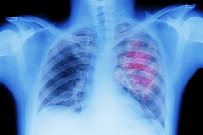 علاج سرطان الرئة