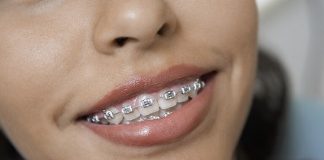 ابتكار مادة ذكية لصنع أجهزة تقويم الأسنان